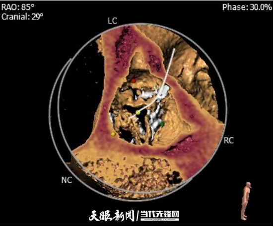 CTA显示主动脉瓣钙化、狭窄、部分瓣叶间融合_副本.jpg