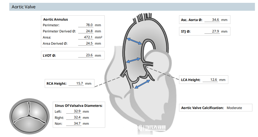 主动脉、主动脉瓣环、冠状动脉开口位置等测量方法及值_副本.png