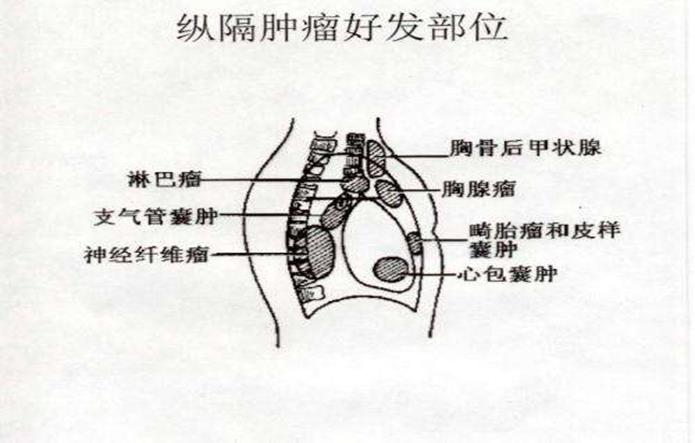 体检发现纵隔肿瘤怎么办