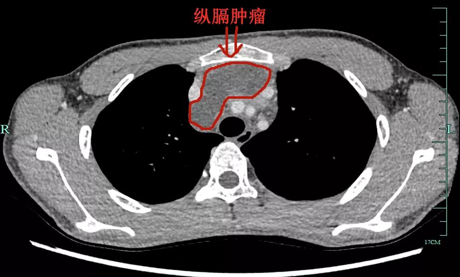 省外少年患巨大纵隔肿瘤辗转贵黔救治成功